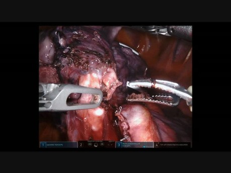 Resección del pulmón por segmentectomía anatómica