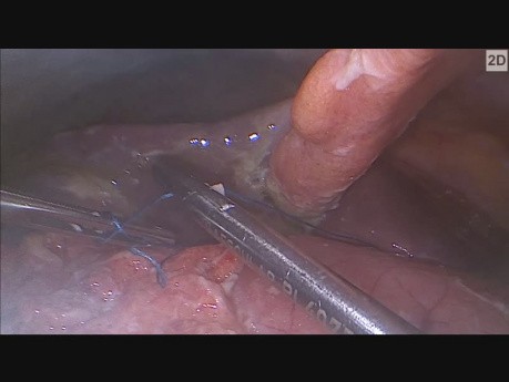 Suministro laparoscópico de la úlcera pilórica perforada