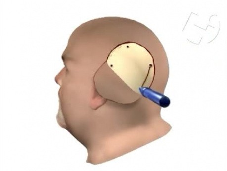 Craneotomía y biopsia