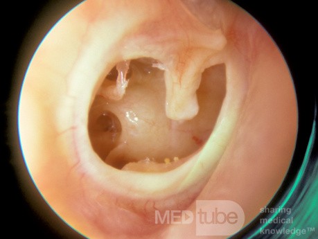 Perforación subtotal - oído derecho