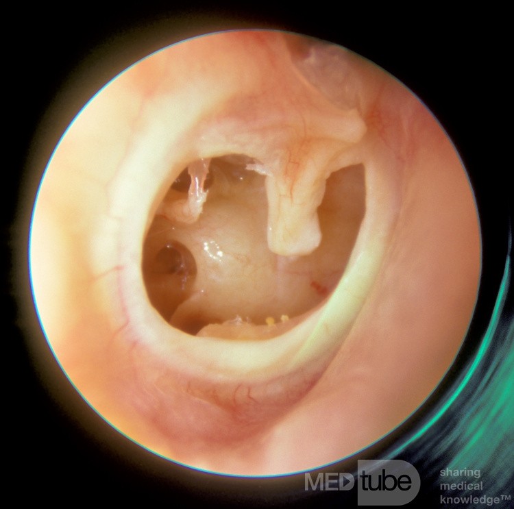 Perforación subtotal - oído derecho
