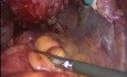 Histerectomía laparoscópica en pelvis congelada