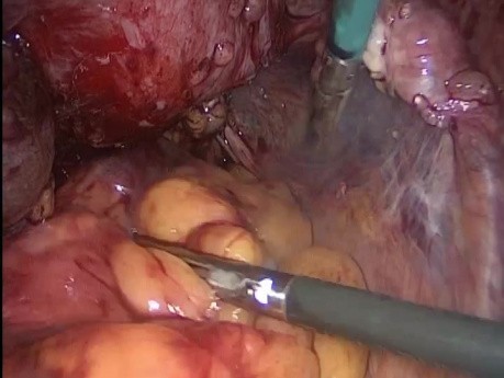 Histerectomía laparoscópica en pelvis congelada