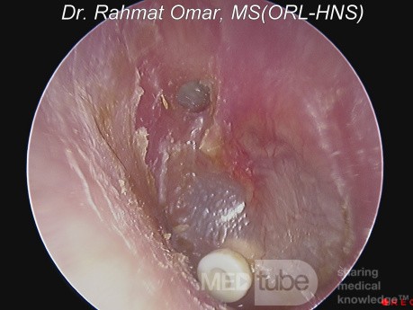 Perforación del ático con queratina y ojal in situ