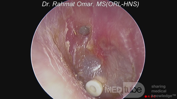 Perforación del ático con queratina y ojal in situ