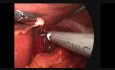 Vagotomía y gastroyeyunostomía laparoscópica 