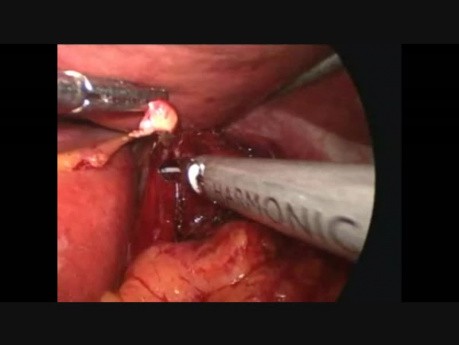Vagotomía y gastroyeyunostomía laparoscópica 