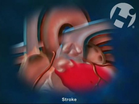 Accidente cerebrovascular y ataque isquémico transitorio