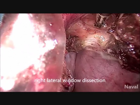 Histerectomía vNOTES difícil por dos cesáreas anteriores con útero fibroide grande con cicatrices