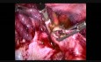 Anexectomía por cáncer de ovario