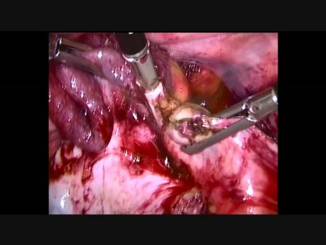 Anexectomía por cáncer de ovario