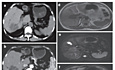 Colangiocarcinoma intrahepático