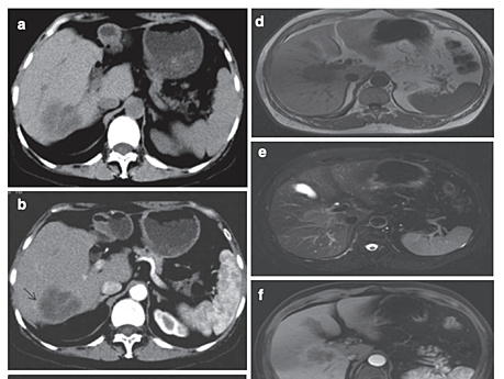 Colangiocarcinoma intrahepático