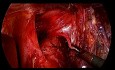 Gastrectomía laparoscópica total para el cáncer de estómago