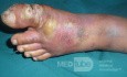 Absceso del hallux