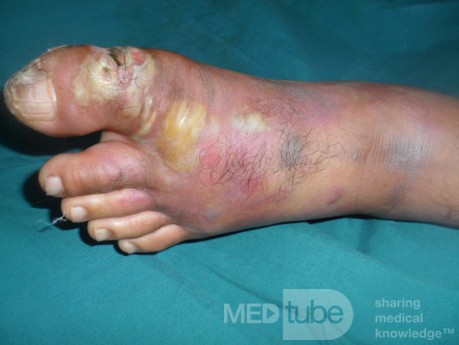 Absceso del hallux