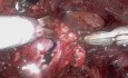 Ultra Minimally Invasive Single Port Robot-Assisted Pyeloplasty