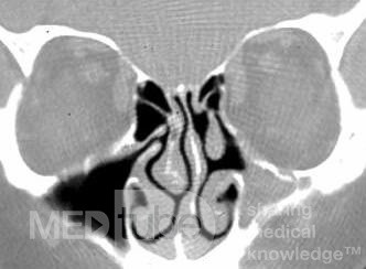 Sinusitis alérgica por hongos