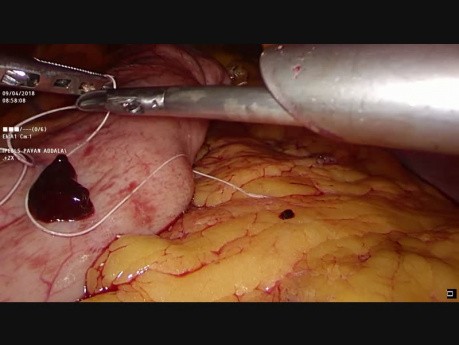 Plicatura gástrica laparoscópica