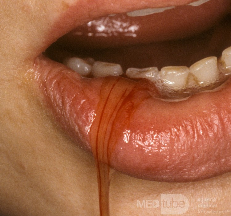 Gran mucocele de labios drenado