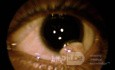 Dermoide limbal