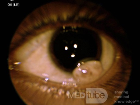 Dermoide limbal