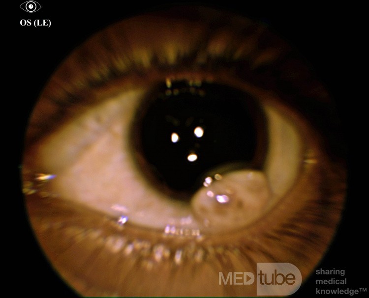 Dermoide limbal