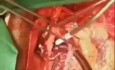 Thrombus Removal from RA
