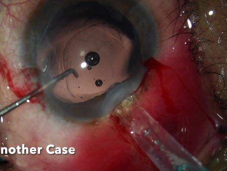 Explicación de la lente intraocular rota: una pesadilla con la que lidiar
