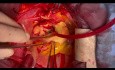 Disección de aorta ascendente y reemplazo de raíz
