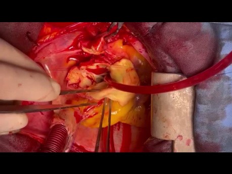 Disección de aorta ascendente y reemplazo de raíz