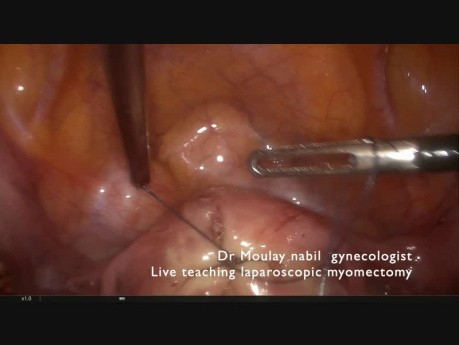 Polimiomectomía laparoscópica - consejos y trucos - cirugía en vivo