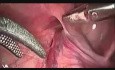Herniotomía laparoscópica