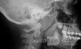 Radiografía lateral de un paciente con agrandamiento de amígdalas y adenoides