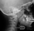 Radiografía lateral de un paciente con agrandamiento de amígdalas y adenoides