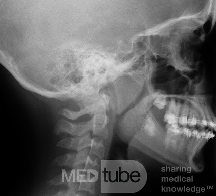 radiografía de adenoides