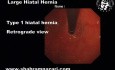 Hernia de hiato tipo 1: vista retrógrada