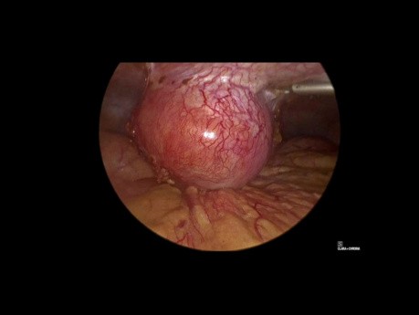 Manejo laparoscópico del absceso en el sitio del puerto secundario a retención de cálculos biliares después de una colecistectomía laparoscópica
