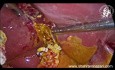Peritonitis biliar por fuga biliar del conducto de Luschka después de colecistectomía laparoscópica