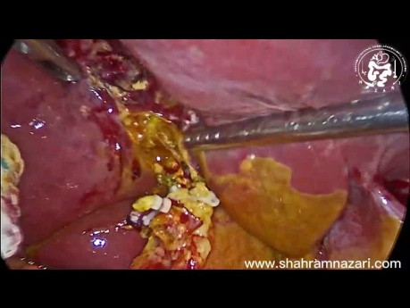Peritonitis biliar por fuga biliar del conducto de Luschka después de colecistectomía laparoscópica