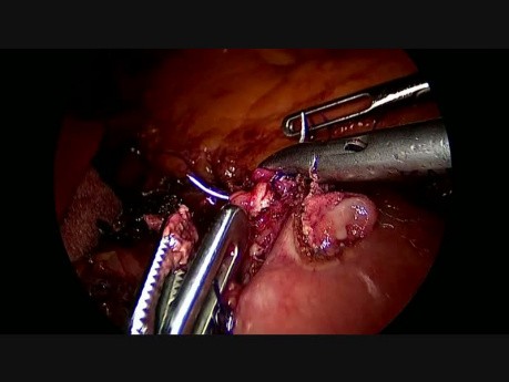 Rehacer cirugía - de la gastroplastia vertical a la RYGB con anillo Fobi 