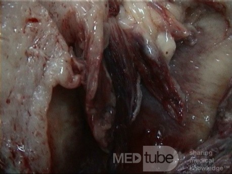 Sarcoma uterino