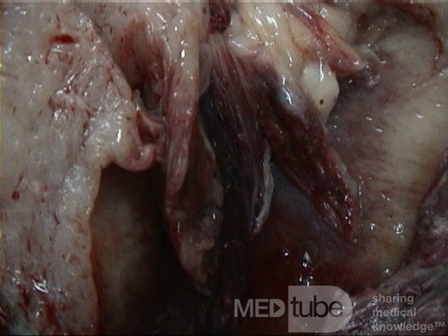 Sarcoma uterino