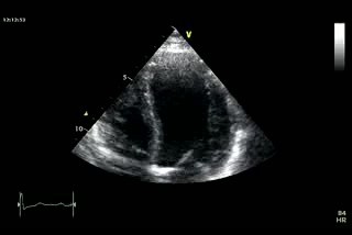 Movimiento paradójico del septo interventricular