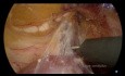Resección segmentaria duodenal
