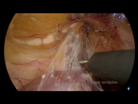 Resección segmentaria duodenal