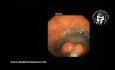 Resección endoscópica de la mucosa (REM) en el tratamiento de pólipos rectales grandes