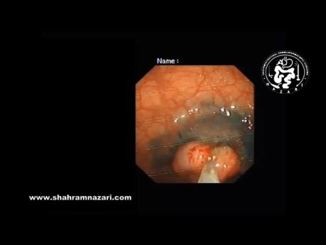 Resección endoscópica de la mucosa (REM) en el tratamiento de pólipos rectales grandes