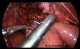 Hepatoyeyunostomía laparoscópica