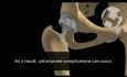 Artroplastia de cadera - complicaciones